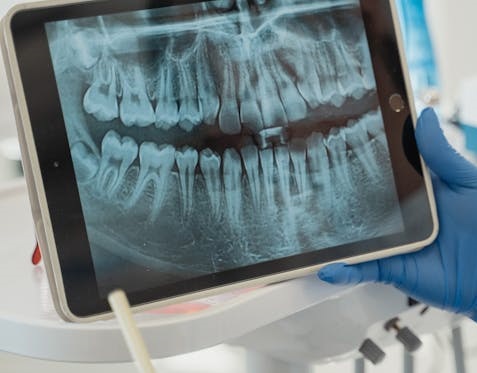 Immagine Scansione intraorale per impronte dentali: come funziona